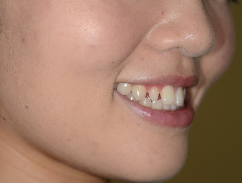 変な歯の形をセラミックで綺麗にする審美歯科