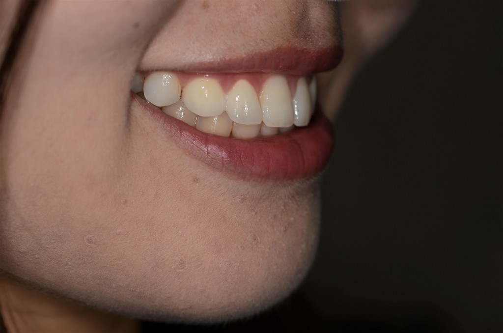 変な歯の形をセラミックで綺麗にする審美歯科