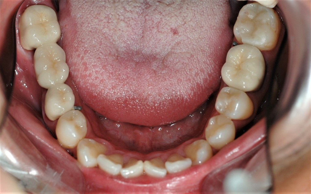 奥の銀歯を白い歯にする審美歯科