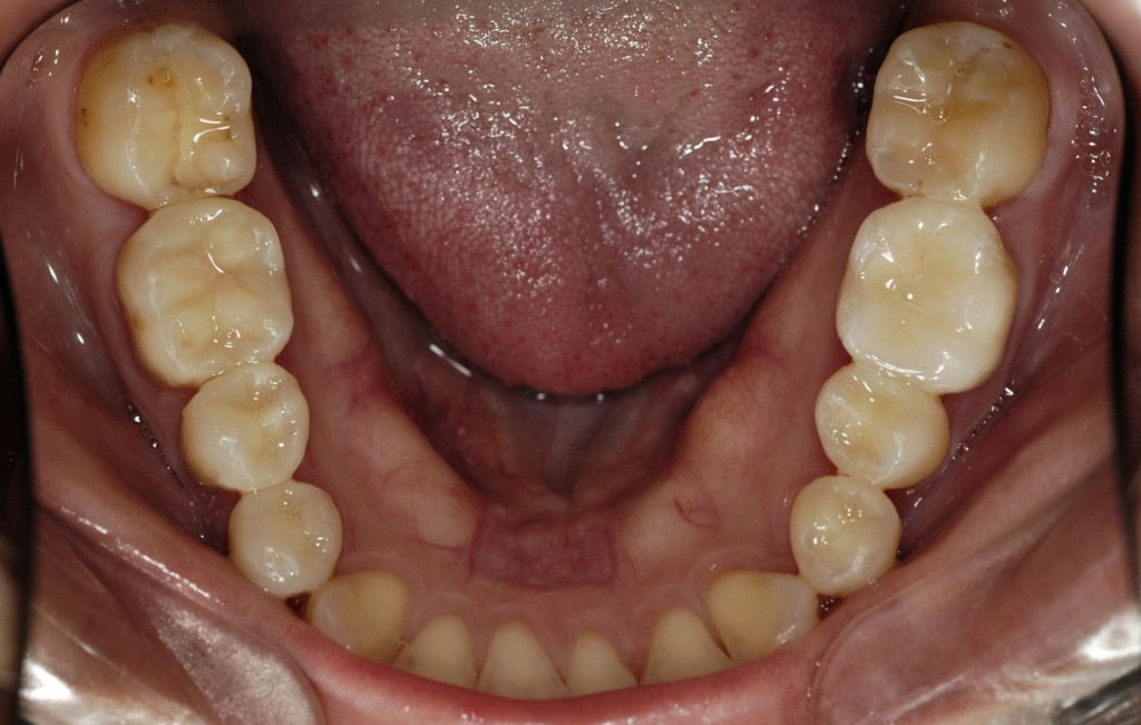 奥歯を白い歯にする審美歯科