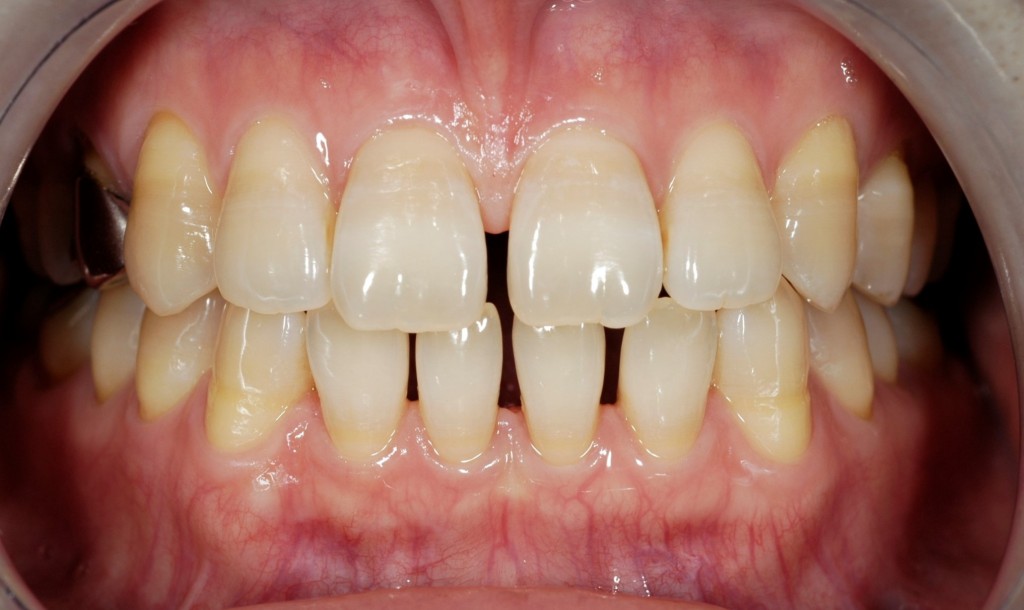 前歯の隙間の矯正治療