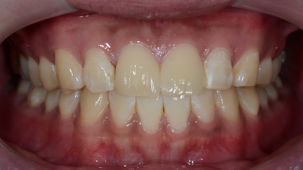 前歯の隙間の治療